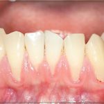 تحلیل لثه در ارتودنسی؛ راهنمای جامع دلایل و راهکارها