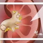 علائم، درمان و باورهای غلط درباره سنگ کلیه