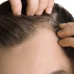 دلیل اصلی ایجاد شوره سر چیست؟ + پیشگیری و درمان
