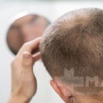 تفاوت ریزش موی هورمونی و ارثی