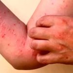 همه چیز درباره ویروس چیکونگونیا + جزییات
