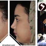 همه‌چیز درباره عمل بینی با عوارض کم؛ از انتخاب جراح تا تکنیک مناسب