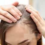 علت ریزش مو در بارداری و راه های درمان آن