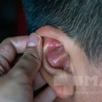 اگزمای لاله گوش: علل، علائم و روش‌های درمان