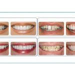 لمینت دندان چیست؟ مزایا، ‌معایب و هزینه‌ها
