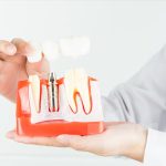 ایمپلنت دندان چیست و چه مزایایی دارد؟